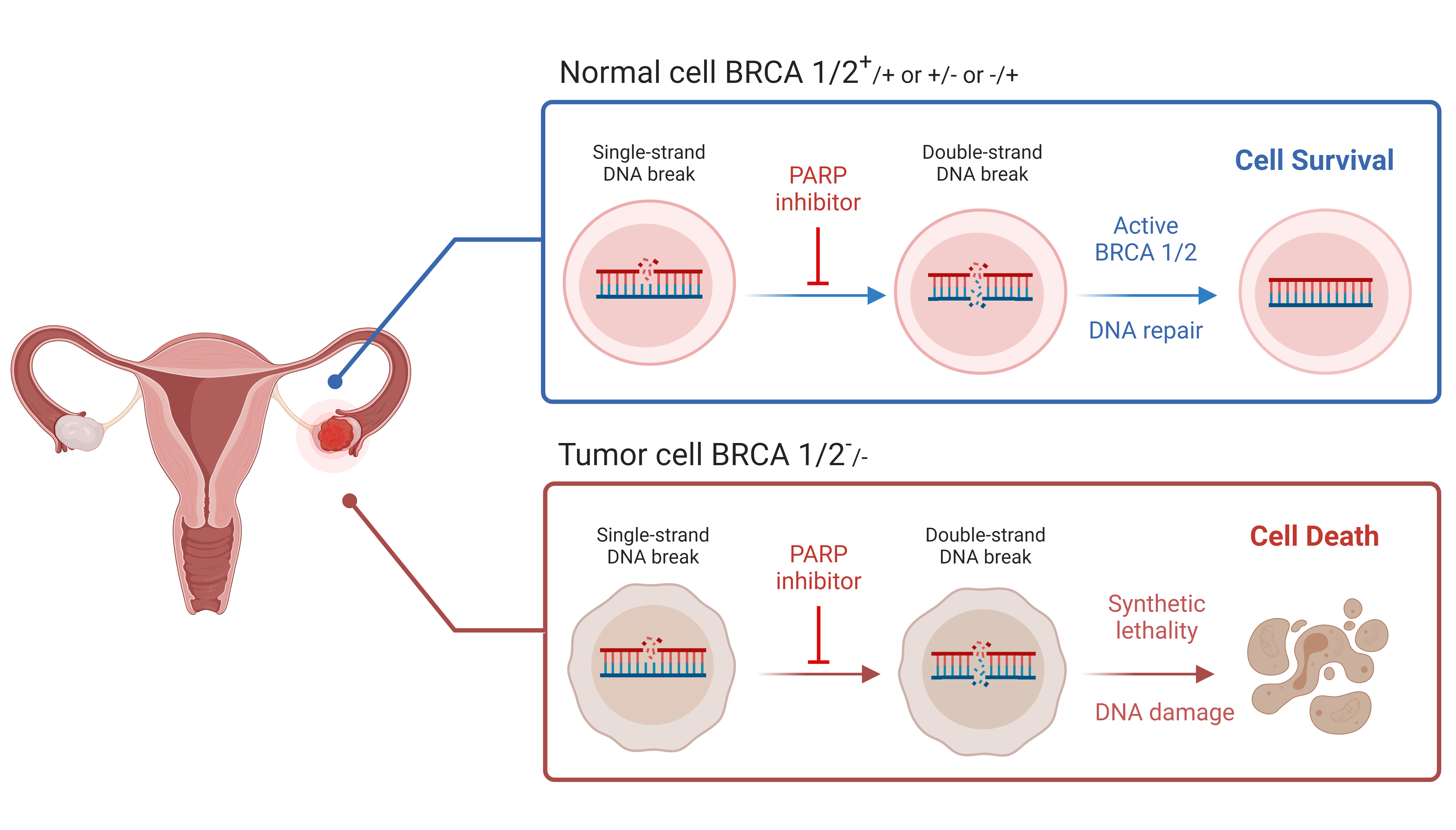 Mechanism of action of PARP inhibitors in BRCA-deficient cancer cells. Inhibition of PARP in addition to deficient homologous recombination repair leads to accumulation of a lethal burden of DNA damage. This is known as synthetic lethality. 
