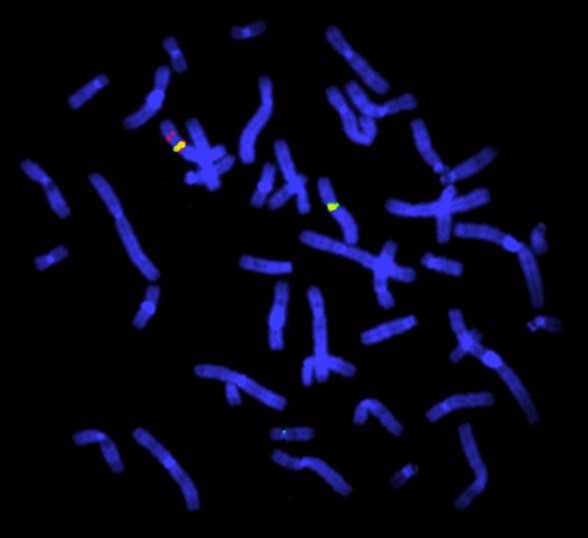 FISH (fluorescence in situ hybridisation) study is of a female heterozygous for a deletion in the Duchenne muscular dystrophy (DMD) gene