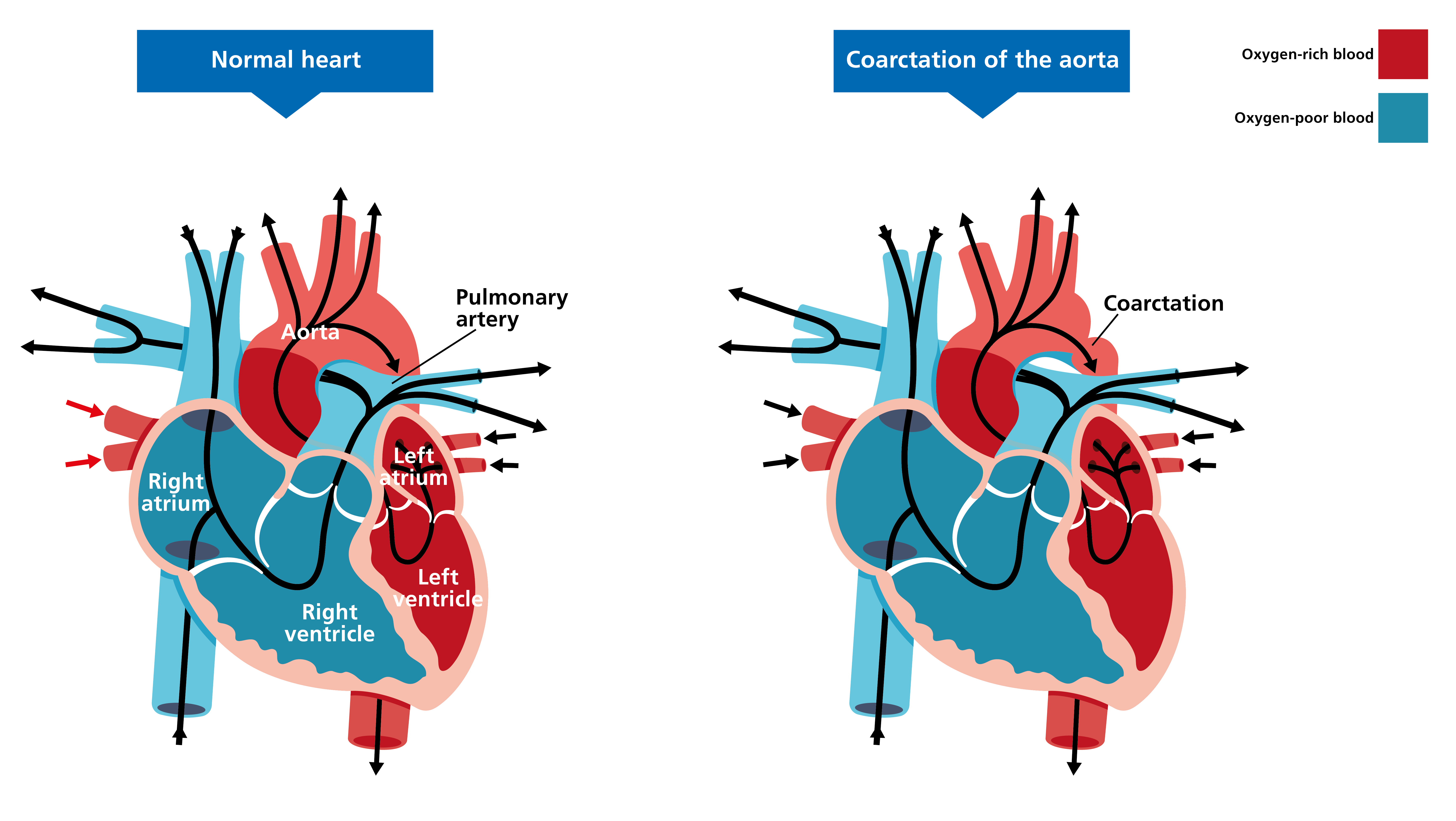 Two illustrated diagrams of hearts, side by side. The one on the left shows a normal heart. The one on the right shows a heart affected by coarctation of the aorta. The affected heart looks the same as the normal heart, except for a pinch-like narrowing of the aorta.