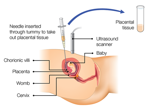 A needle is inserted through the stomach to take out placental tissue, using ultrasound guidance. The baby, the chorionic villi, the placenta, the womb and the cervix are all labelled.