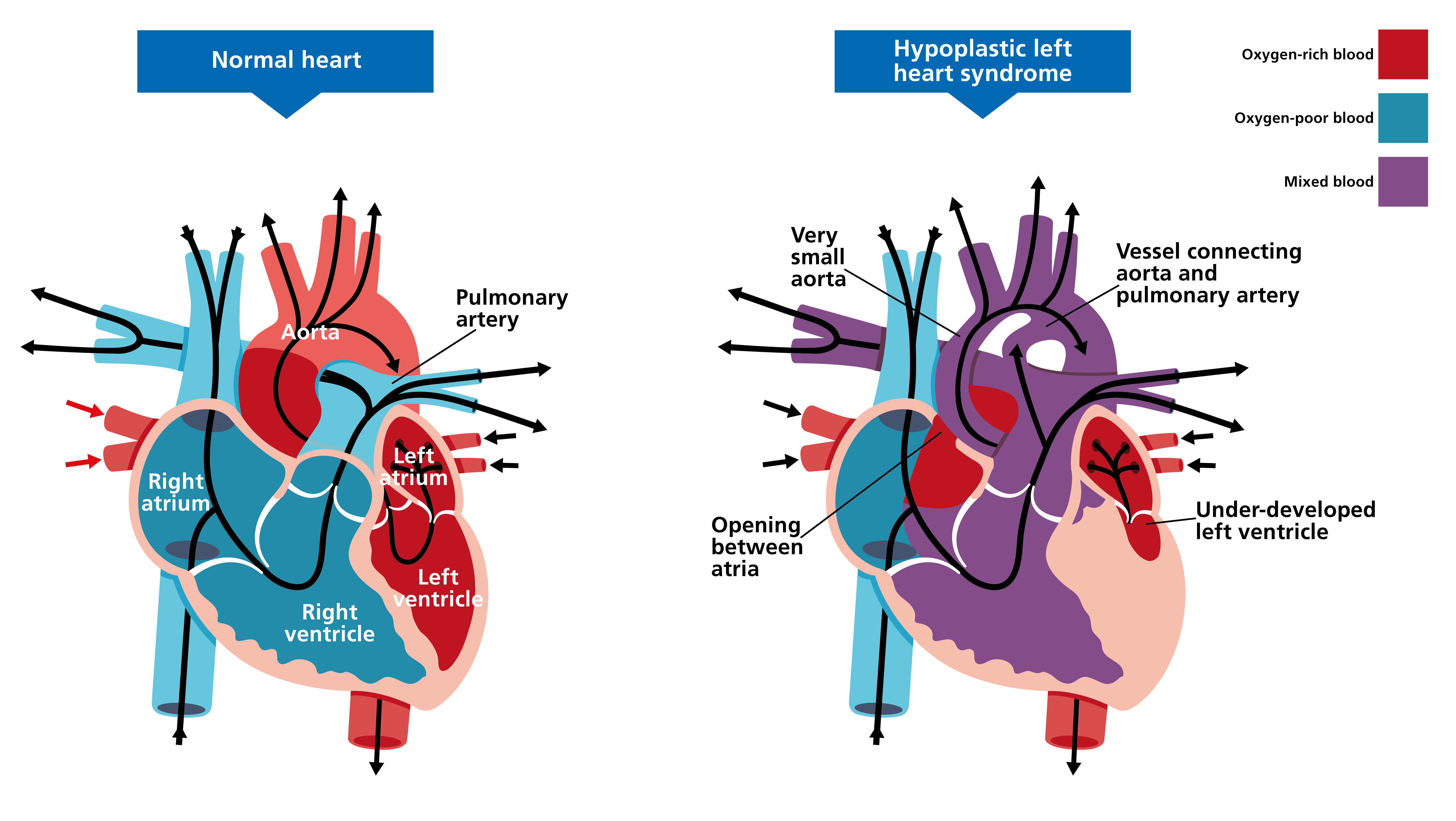 Two illustrated diagrams of hearts, side by side. The one on the left shows a normal heart; the one on the right shows a heart affected by hypoplastic left heart syndrome. Features of the affected heart include a very small aorta, an opening between atria, and an under-developed left ventricle. These features are labelled.