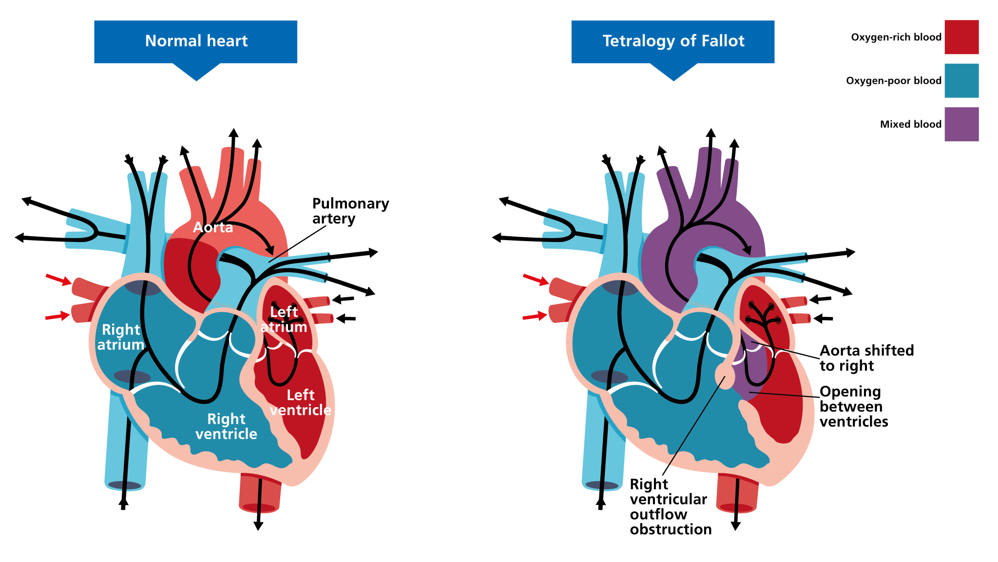 tetralogy of fallot case study