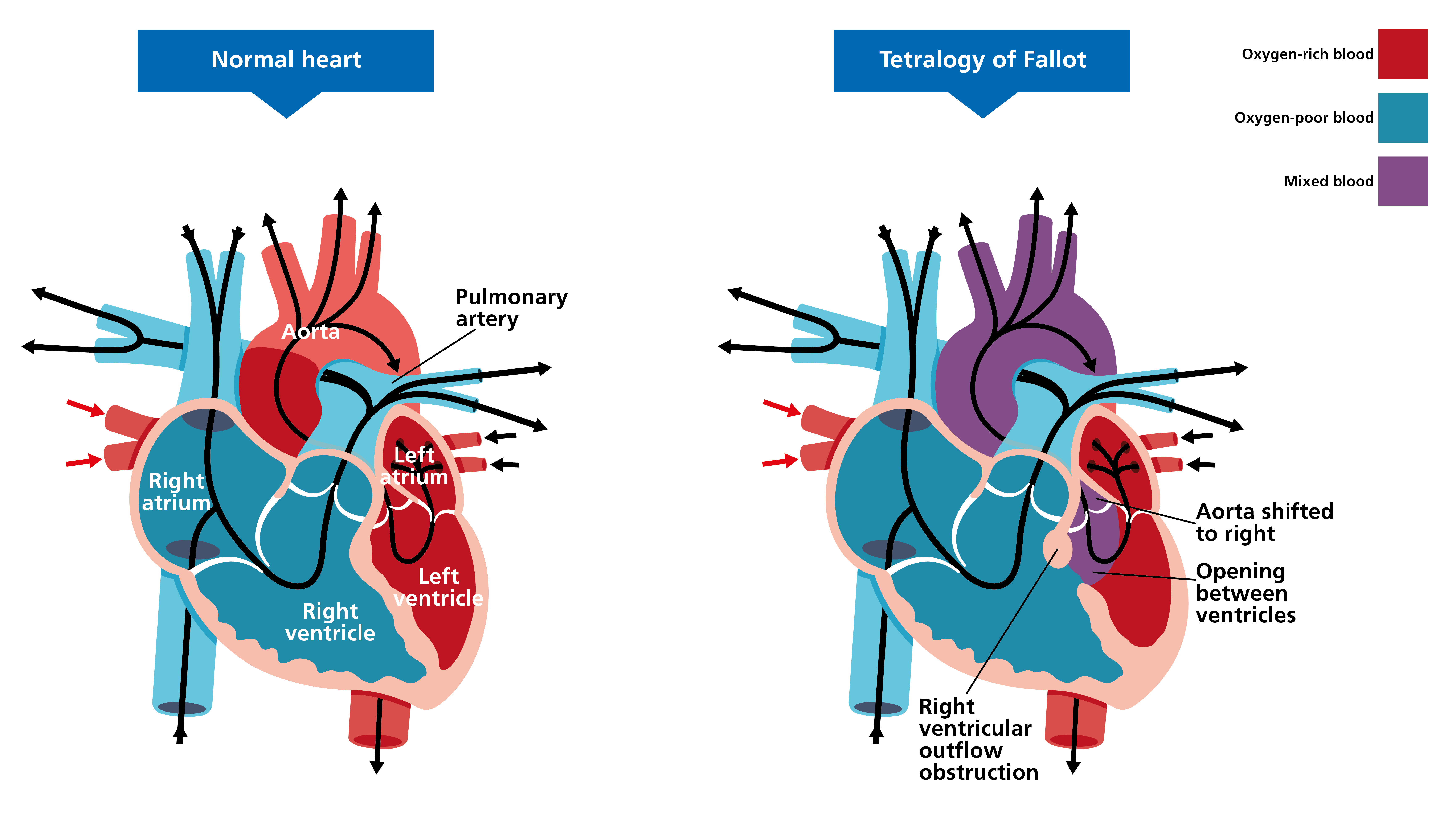 Two illustrated diagrams of hearts, side by side. The one on the left shows a normal heart. The one on the right shows a heart affected by Tetralogy of Fallot. Features of the affected heart include an aorta that has shifted to the right, an obstruction in the right ventricular outflow, and an opening between the ventricles.