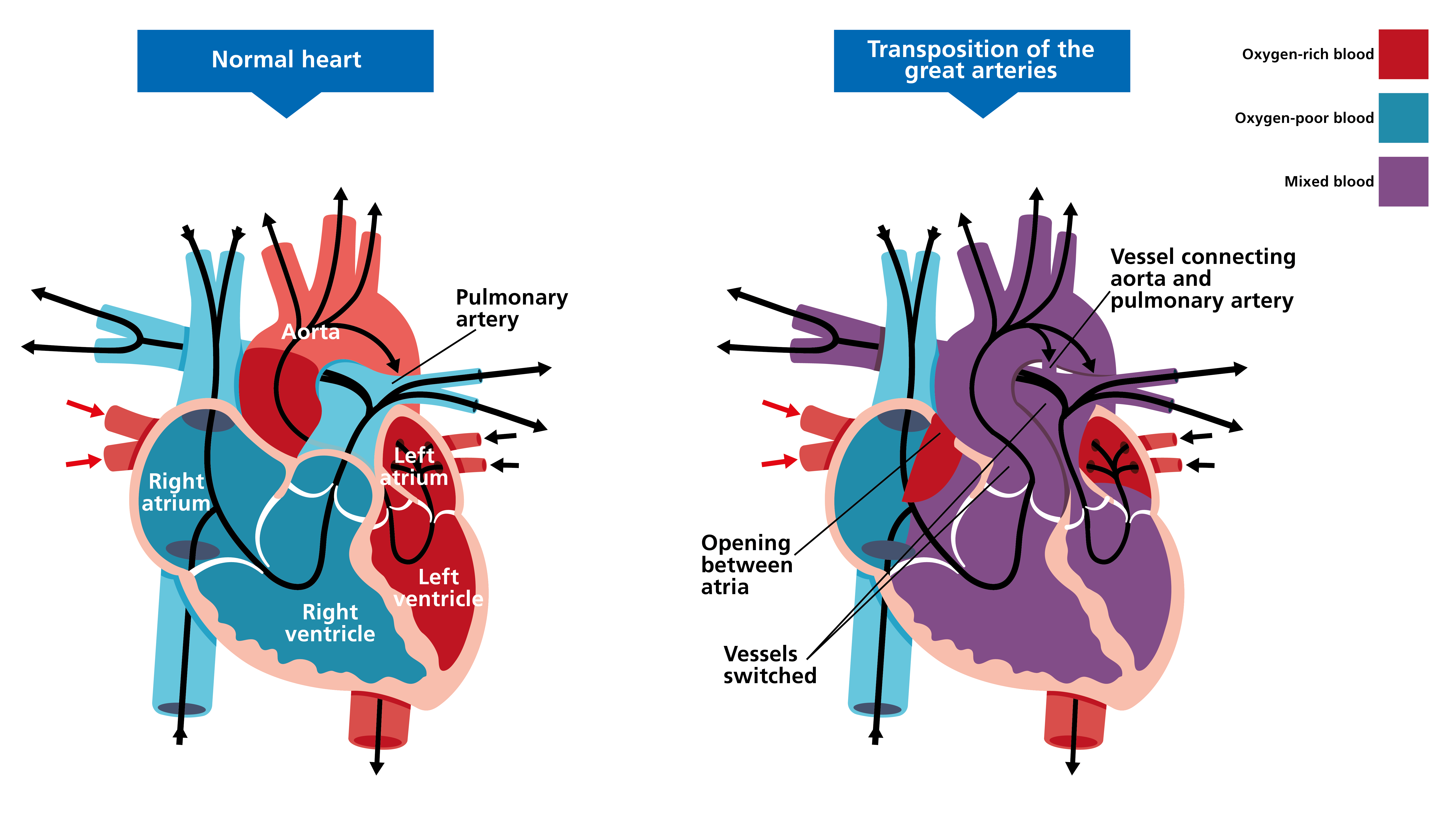 Two illustrated diagrams of hearts, side by side. The one on the left shows a normal heart. The one on the right shows a heart affected by transposition of the great arteries. Features of the affected heart include an opening between the atria, vessels switched, and a vessel connecting the aorta and the pulmonary artery.