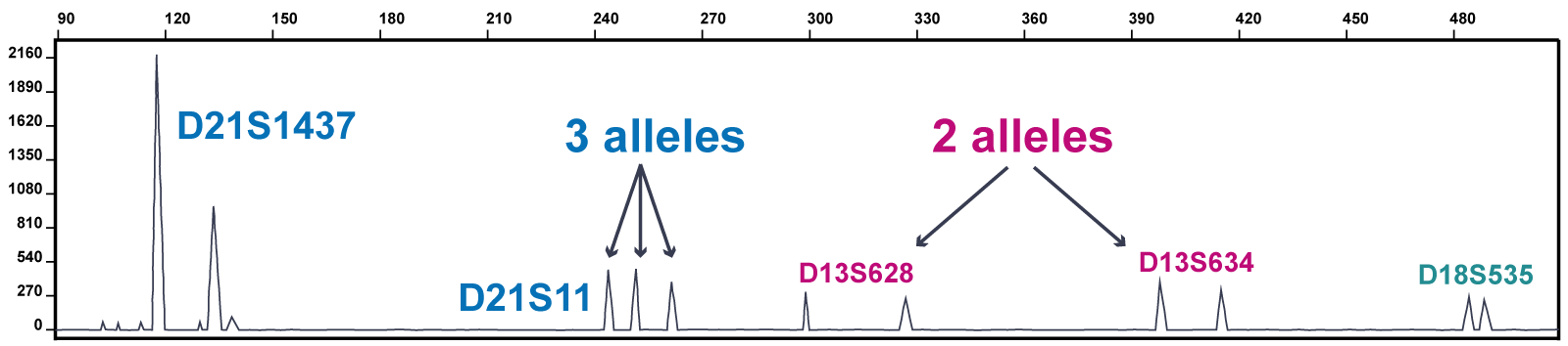 Part of a trace from a QF-PCR test showing the results from several markers across chromosomes 13, 18 and 21 (the marker labels begin D13, D18 and D21 to indicate the chromosome of origin). This trace shows trisomy 21. The marker D21S1437 has an abnormal peak ratio: the first peak is twice the height of the second peak. The marker D21S11 has an abnormal number of peaks (three). The markers from the other chromosomes show two peaks of equal height.