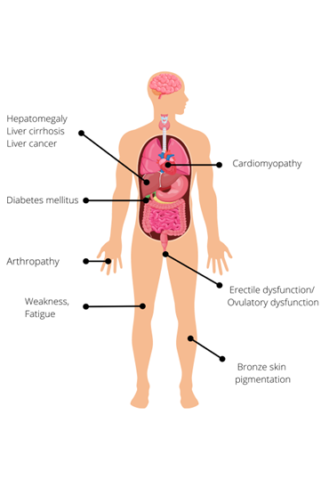 An illustrated human body with the following labels: Hepatomegaly, liver cirrhosis, liver cancer (pointing to the liver); Cardiomyopathy (pointing to the heart); Diabetes mellitus (pointing to the pancreas); Erectile dysfunction/ovulatory dysfunction (pointing to the genitals); Weakness, fatigue (pointing to the knees); Arthropathy (pointing to the fingers).