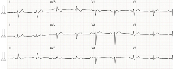 ECG from a patient with an SCN5A pathogenic variant demonstrating first degree AV block and intraventricular conduction delay.