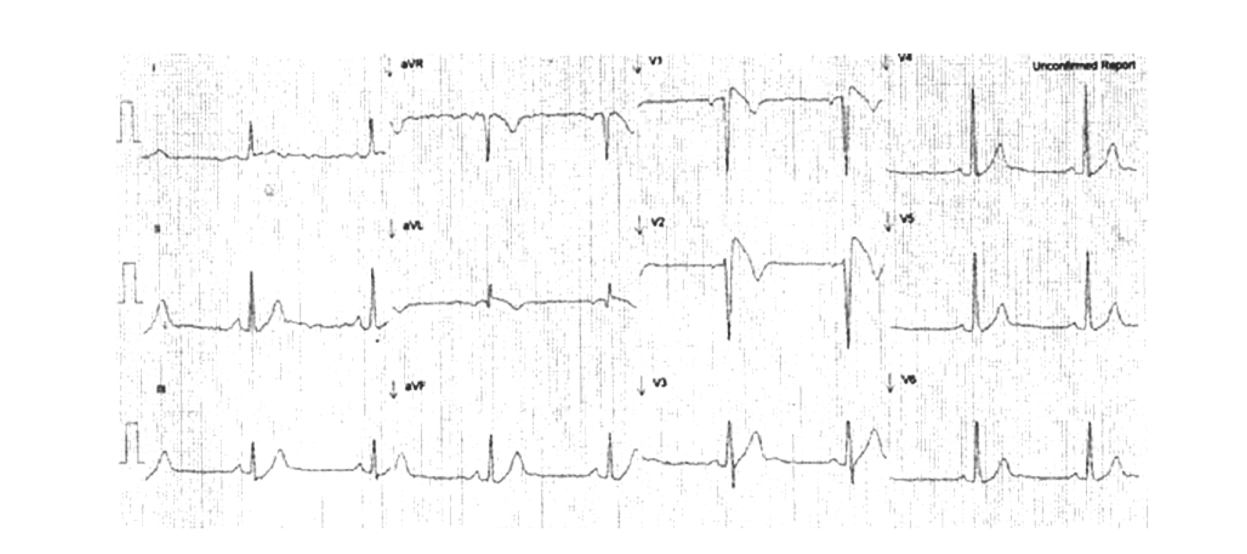 ECG demonstrating the type 1 Brugada ECG pattern in standard leads V1 and V2.