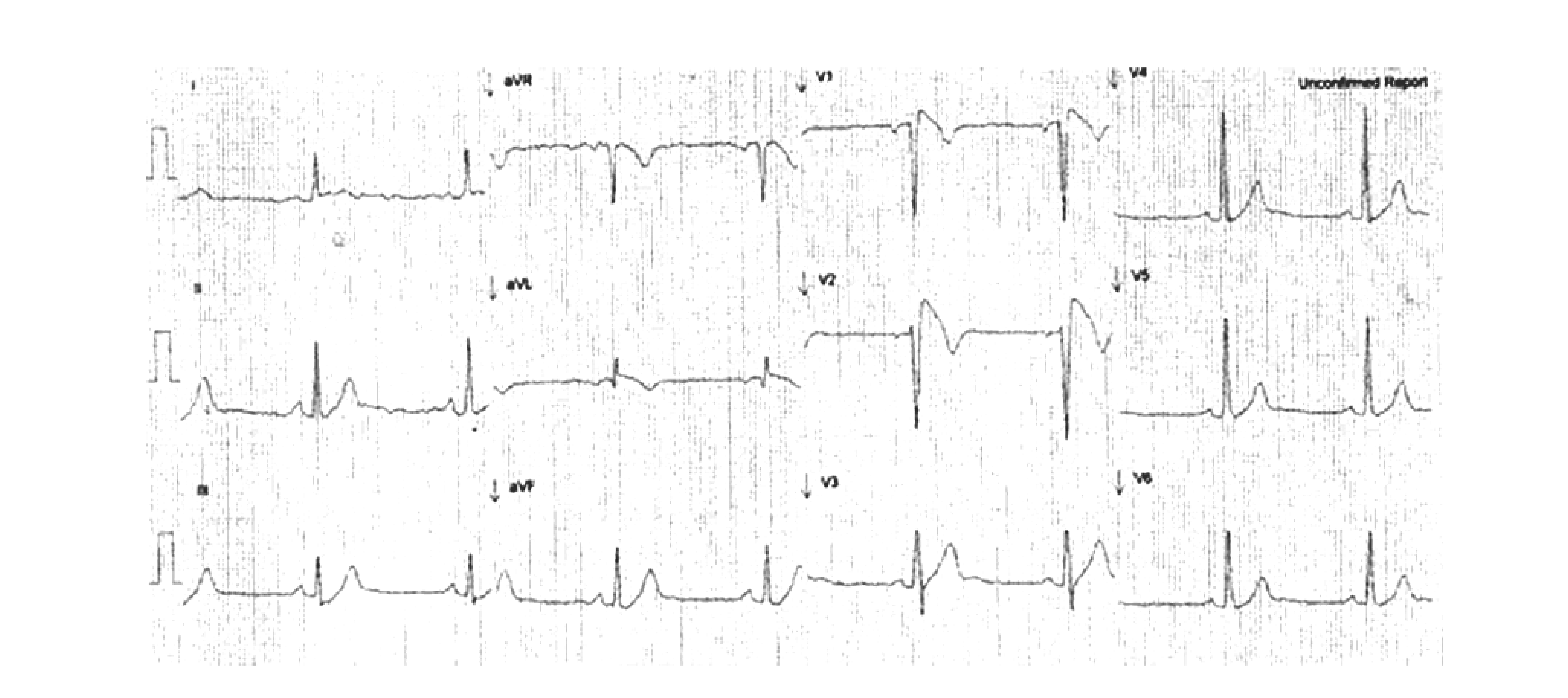 ECG demonstrating the type 1 Brugada ECG pattern in standard leads V1 and V2.