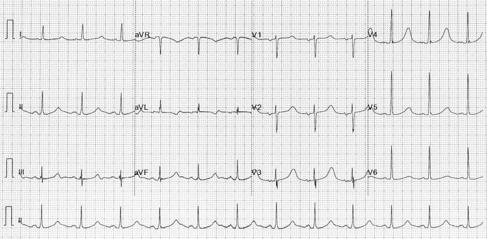 ECG demonstrating QT prolongation in a patient with Jervell and Lange-Nielson syndrome.