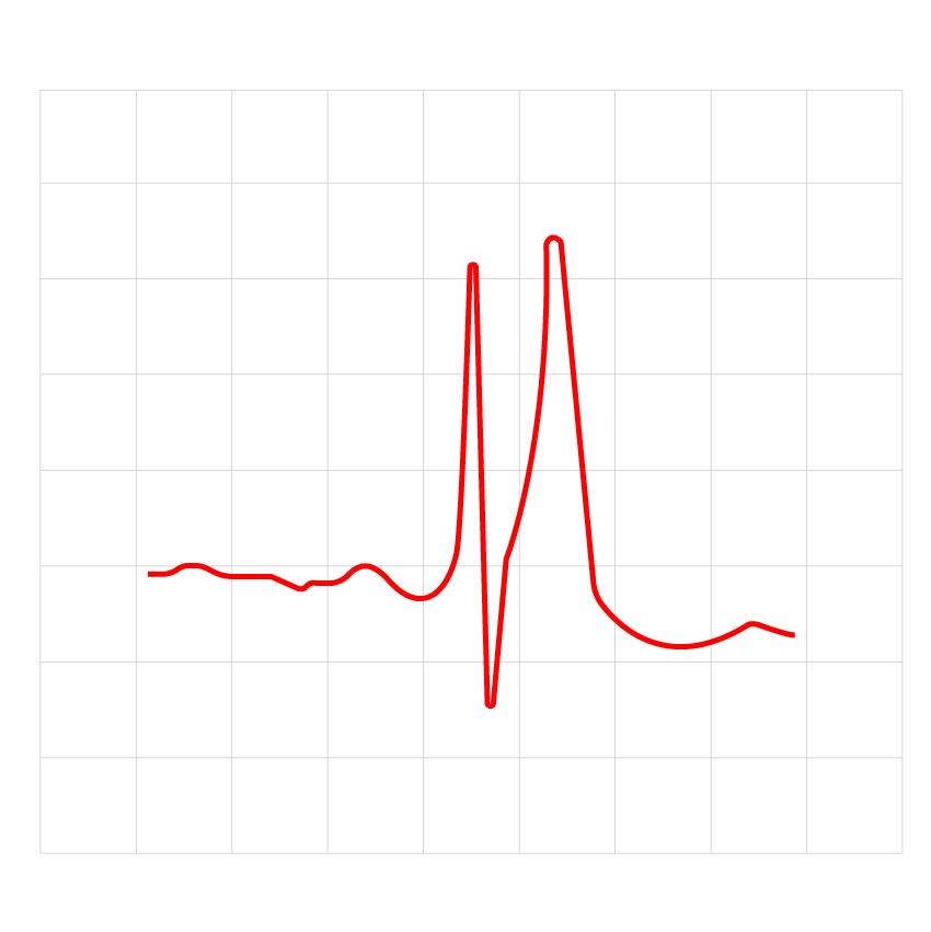 The ECG result of an adult patient with short QT syndrome.