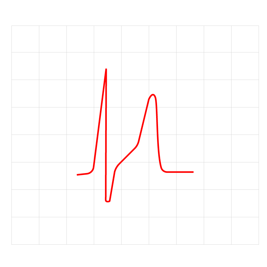 An ECG result showing SQT caused by the KCNH2 gene.
