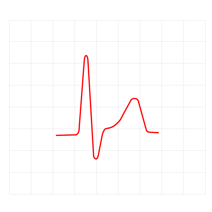  An ECG result showing SQT caused by the KCNQ1 gene.