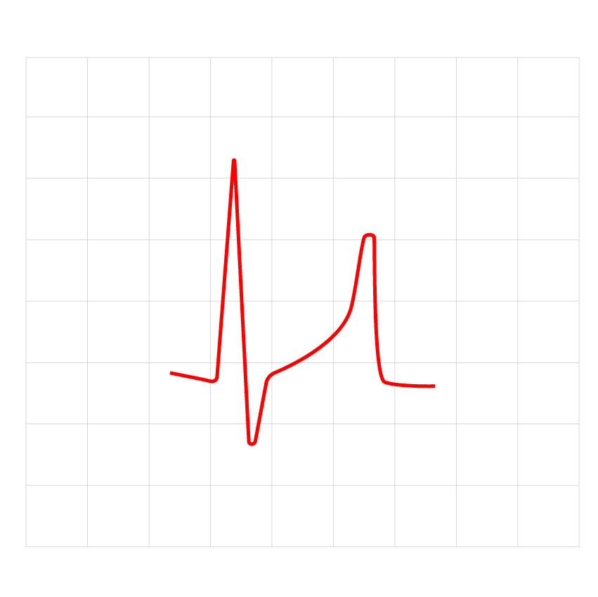  An ECG result showing SQT caused by the KCNJ2 gene.