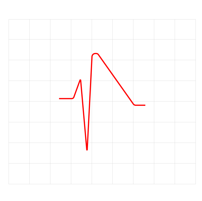  An ECG result showing SQT caused by the CACNB2B gene.