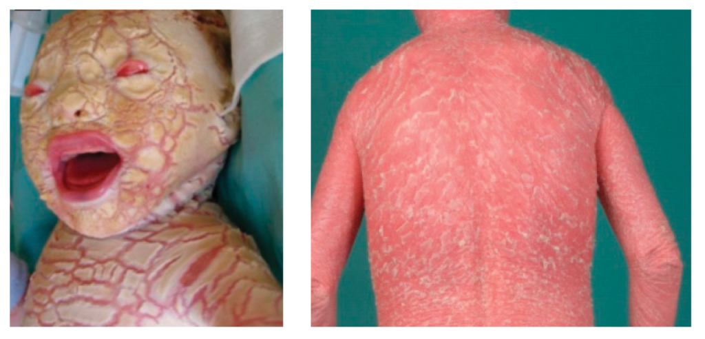 A baby with harlequin ichthyosis, with a collodion membrane, and later in life, with extremely thickened skin.
