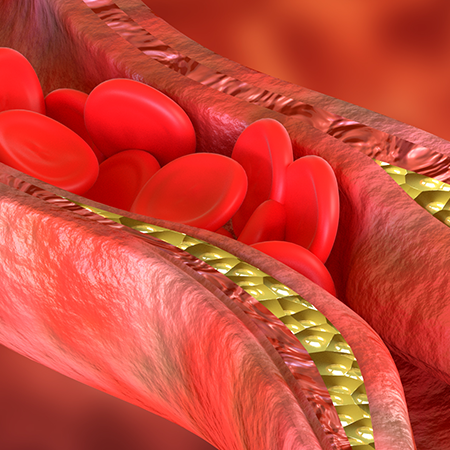 Artery with cholesterol build-up and stuck red blood cells