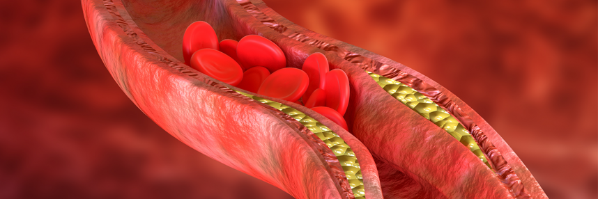 Artery with cholesterol build-up and stuck red blood cells